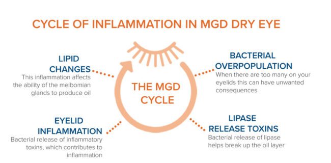 A diagram of inflammation in the mgd process.
